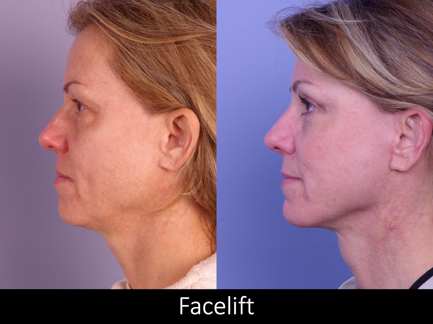 Facelift And Neck Lift Before And After Raval Facial Aesthetics Denver